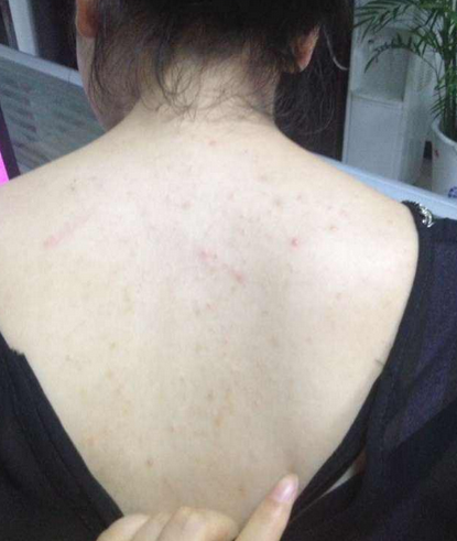 夏日美背无忧 老中医教你用“它”扫光后背疙瘩，重拾光滑肌肤